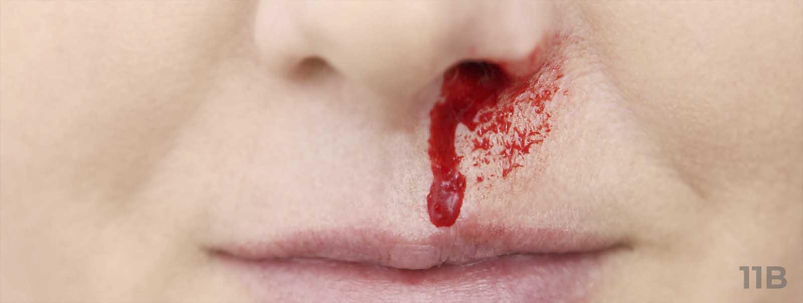 Leben mit ITP: Teaserbild zum Artikel „Symptome“