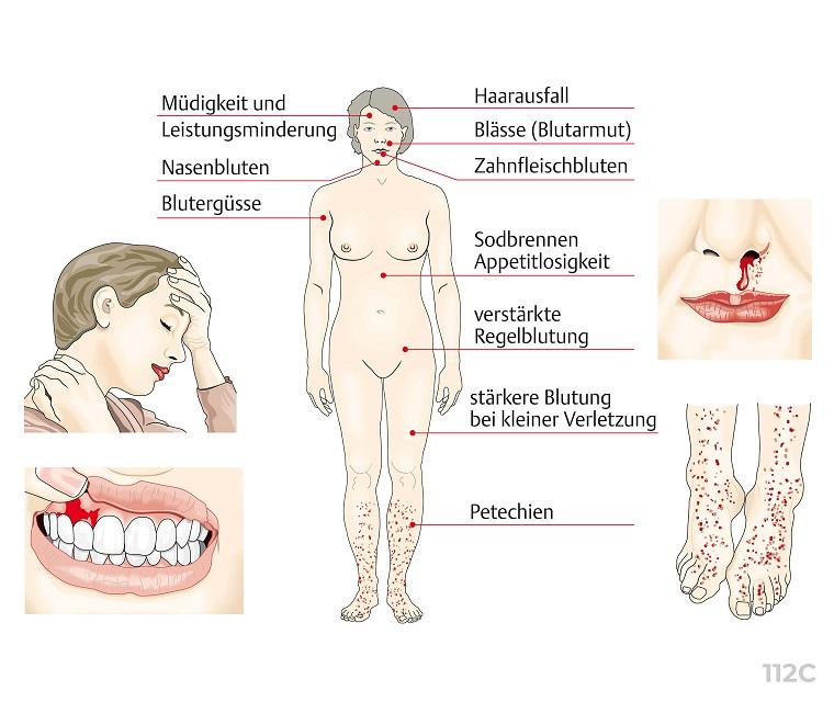 Symptome Der Immunthrombozytopenie Leben Mit Itp