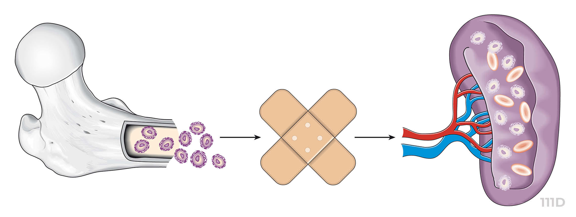Leben mit ITP: Die Grafik zeigt die Folgen eines Thrombozytenmangels
