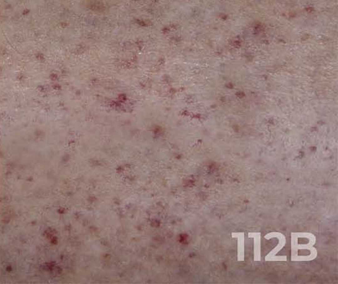 Kleine Rote Flecken Am Bauch